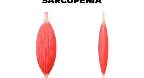 Sarcopenia: Obiettivi Emergenti e Trattamenti Innovativi per la Salute Muscolare